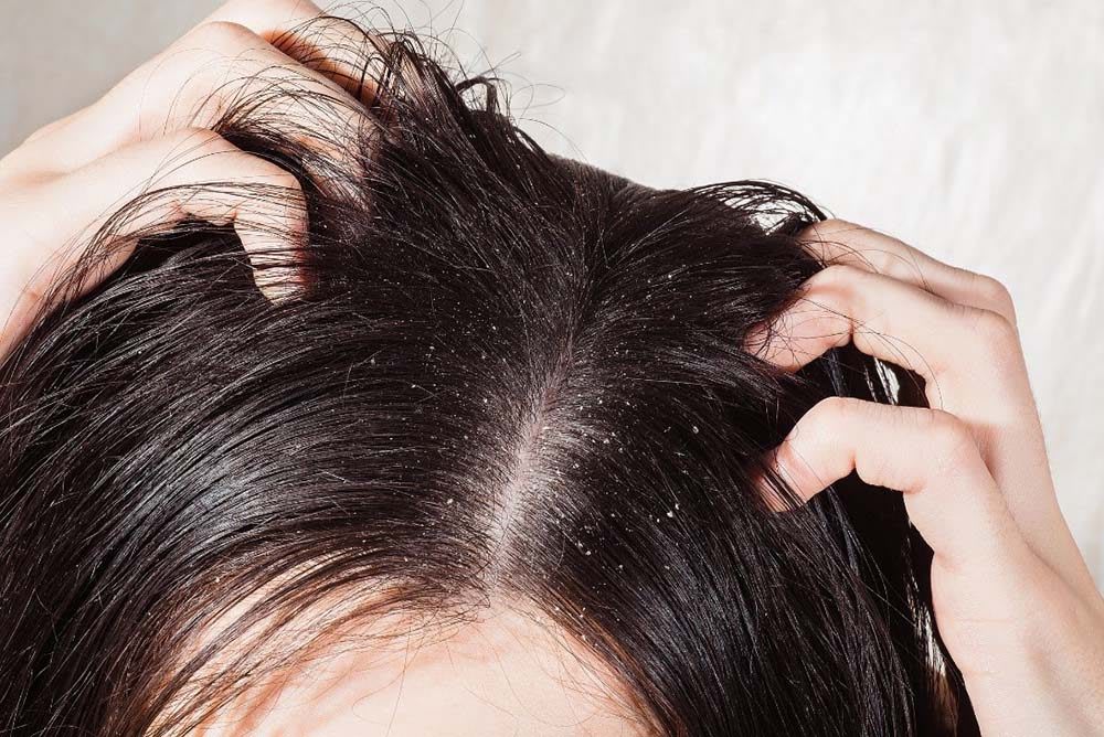 Pellicules causes, types et solutions efficaces