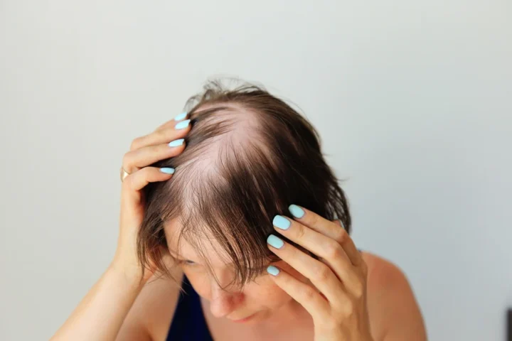 Stress et chute de cheveux